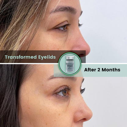 HyaT™ Upper & Lower Eyelid Micro-Infusion System