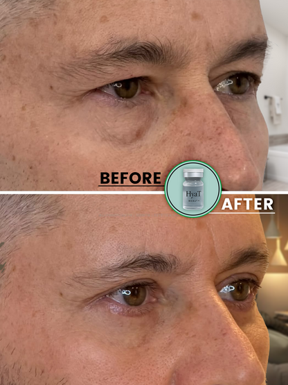 HyaT™ Upper & Lower Eyelid Micro-Infusion System for Men