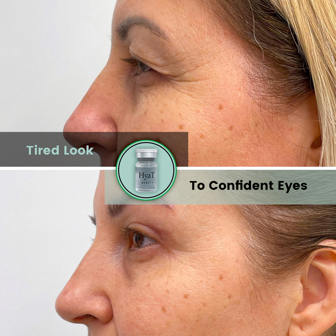 HyaT™ Upper & Lower Eyelid Micro-Infusion System