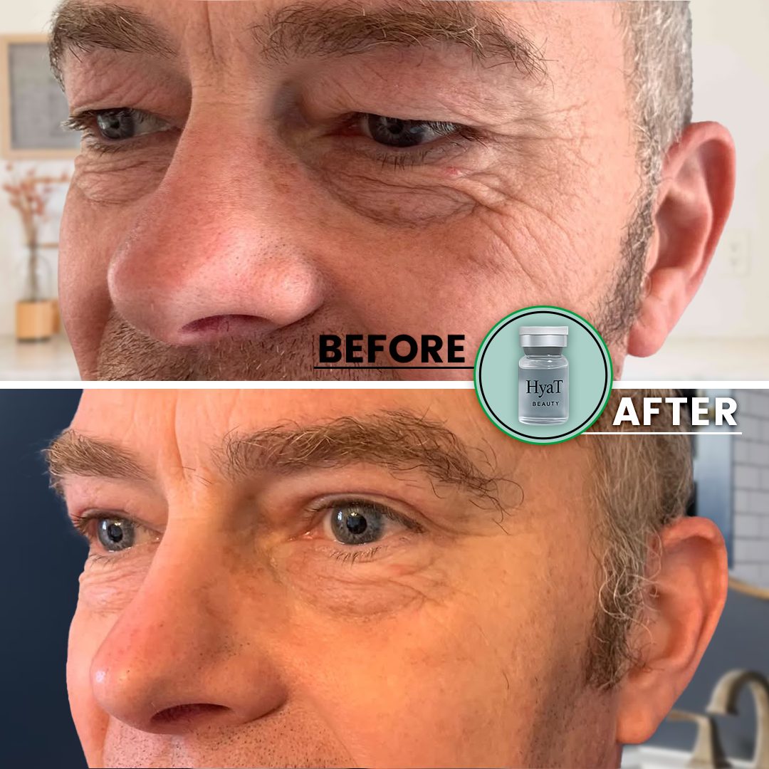 HyaT™ Upper & Lower Eyelid Micro-Infusion System for Men