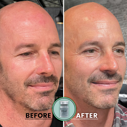 HyaT™ Upper & Lower Eyelid Micro-Infusion System for Men