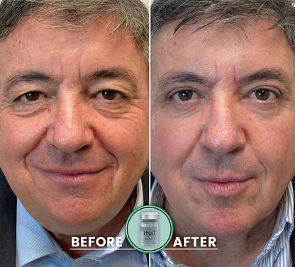 HyaT™ Upper & Lower Eyelid Micro-Infusion System for Men
