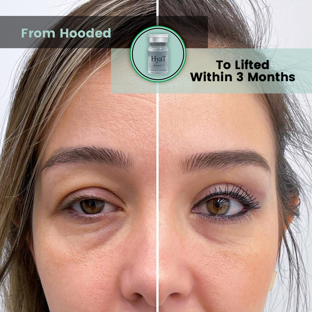 HyaT™ Upper & Lower Eyelid Micro-Infusion System