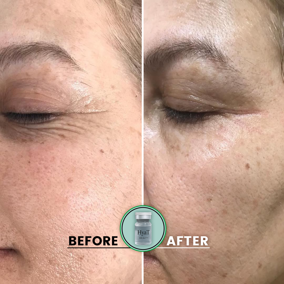 HyaT™ Lower & Upper Eyelid Micro-Infusion System