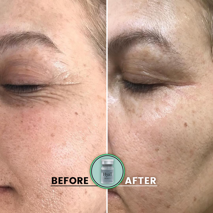 HyaT™ Lower & Upper Eyelid Micro-Infusion System