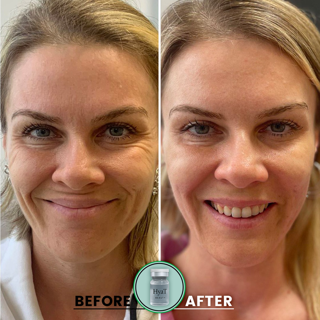 HyaT™ Lower & Upper Eyelid Micro-Infusion System
