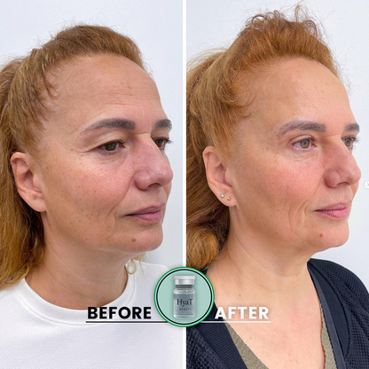 HyaT™ Upper & Lower Eyelid Micro-Infusion System