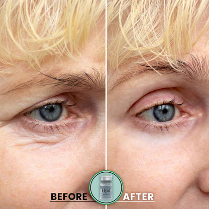HyaT™ Upper & Lower Eyelid Micro-Infusion System