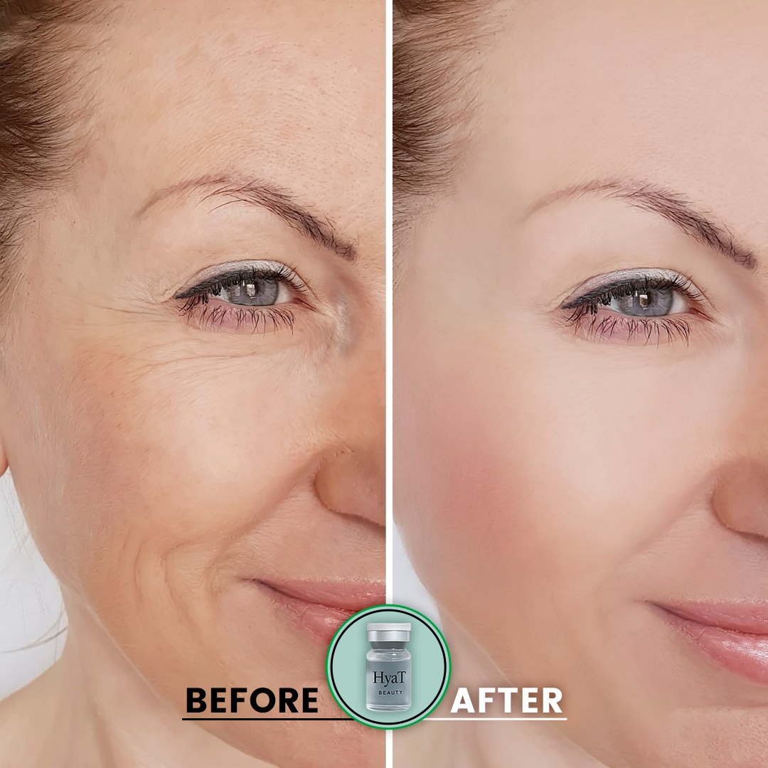 HyaT™ Lower & Upper Eyelid Micro-Infusion System
