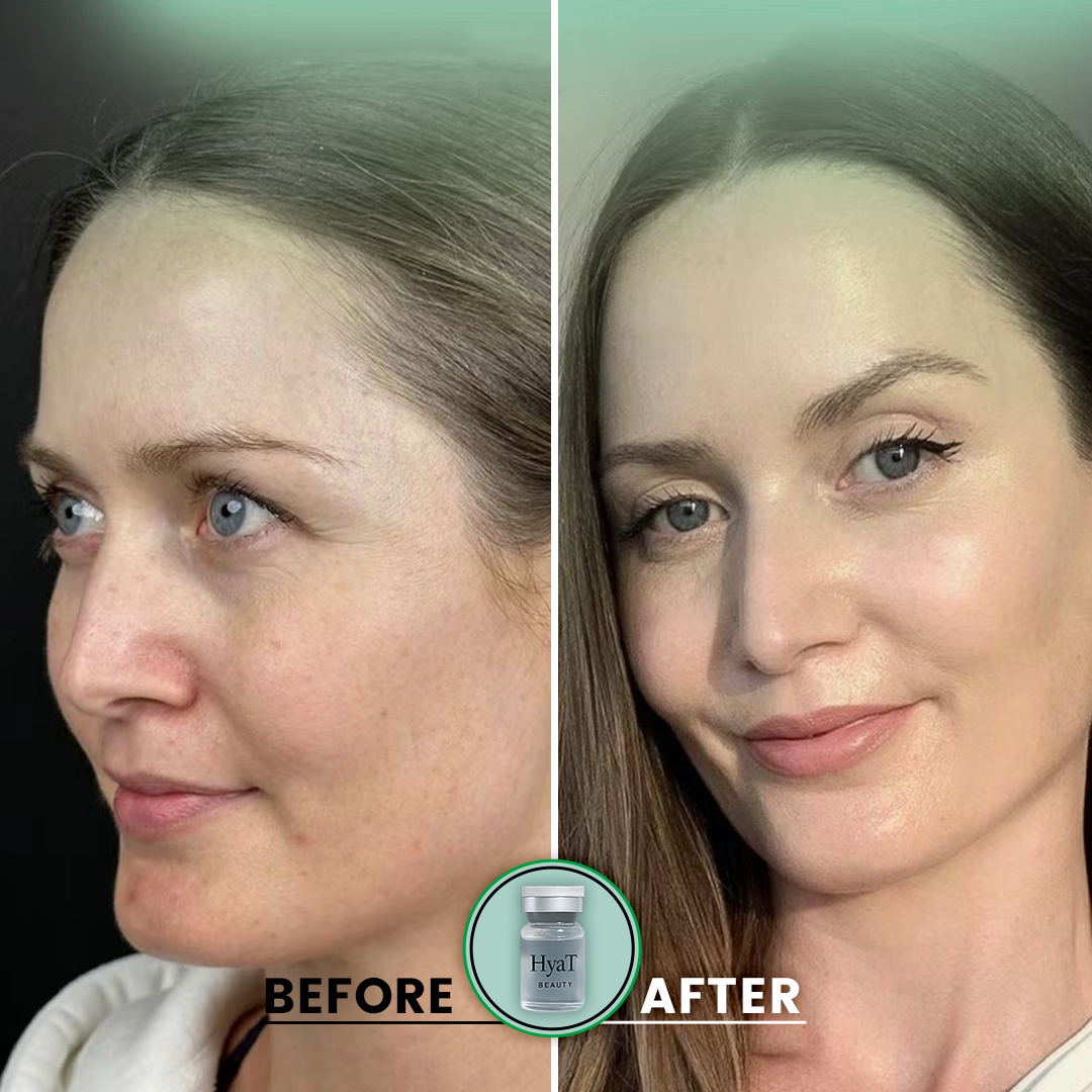 HyaT™ Upper & Lower Eyelid Micro-Infusion System