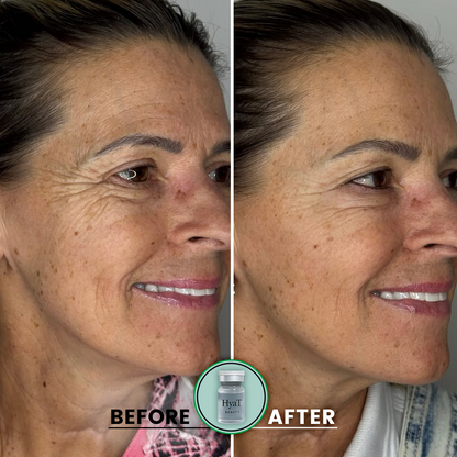 HyaT™ Lower & Upper Eyelid Micro-Infusion System
