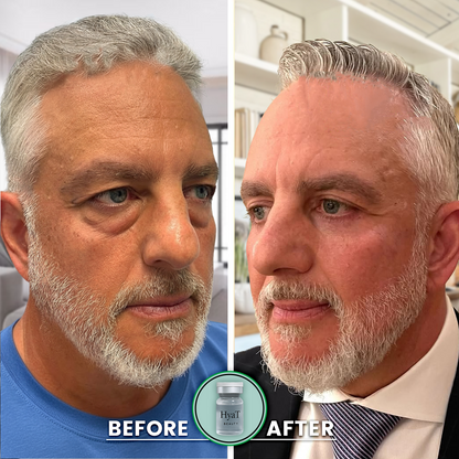 HyaT™ Upper & Lower Eyelid Micro-Infusion System for Men