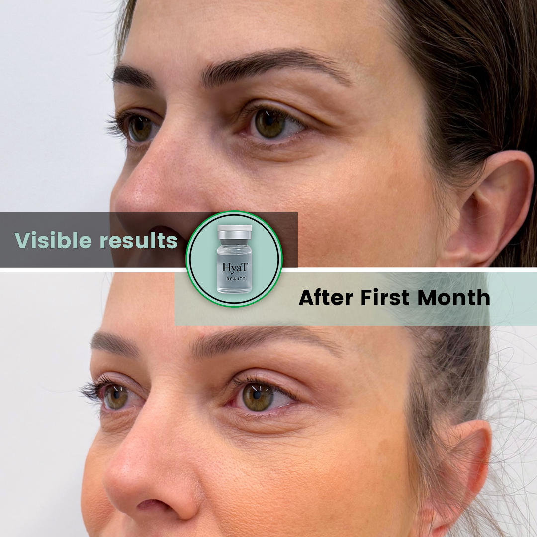 HyaT™ Upper & Lower Eyelid Micro-Infusion System